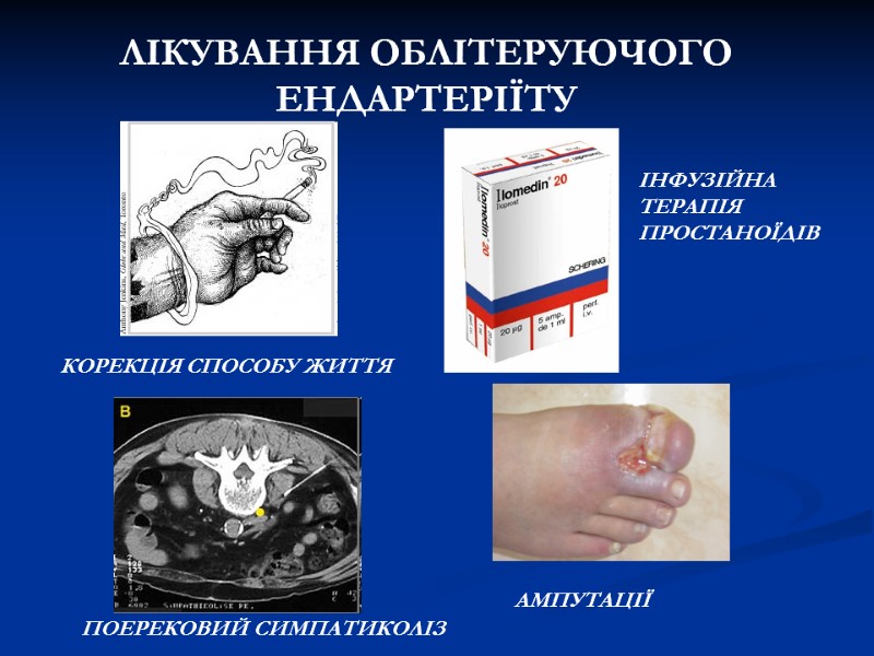 ЛІКУВАННЯ ОБЛІТЕРУЮЧОГО ЕНДАРТЕРІЇТУ КОРЕКЦІЯ СПОСОБУ ЖИТТЯ ПОЕРЕКОВИЙ СИМПАТИКОЛІЗ ІНФУЗІЙНА ТЕРАПІЯ ПРОСТАНОЇДІВ АМПУТАЦІЇ ЛІКУВАННЯ ОБЛІТЕРУЮЧОГО ЕНДАРТЕРІЇТУ КОРЕКЦІЯ СПОСОБУ ЖИТТЯ ПОЕРЕКОВИЙ СИМПАТИКОЛІЗ ІНФУЗІЙНА ТЕРАПІЯ ПРОСТАНОЇДІВ АМПУТАЦІЇ